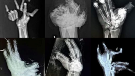 "STIGNE MI ŠAKA U NAJLONU, PADAJU KOMADI KOST, A DETE..." Ove reči doktorke iz Hitne o petardama će sad svi dobro da zapamte