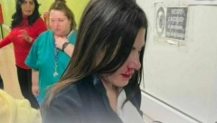 MEDICINSKA SESTRA ANA ZVERSKI PRETUČENA U čekaonici joj prišao muškarac, a onda je usledio horor: "Izbio mi je zub i polomio nos" (FOTO)