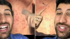 DEVOJCI JE KOŽA BILA UNIŠTENA Doktor otkrio koji predmet iz kozmetičke torbice je uzrokovao osip po telu koji je jedva izlečila