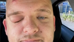 IMAO BUBULJICU NA ČELU, A ONDA MU IZ IZRASLINE ISKOČILO OVO Počelo je da se KOPRCA, nije mogao da veruje ŠTA JE (VIDEO)