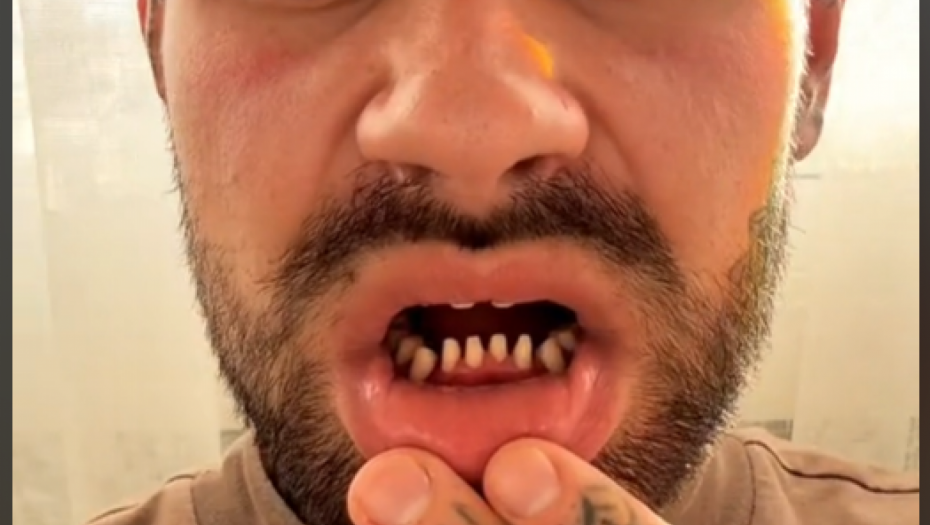 OTIŠAO U TURSKU PO NOVE ZUBE, PA USLEDIO HOROR Želja za beljim osmehom dovela do katastrofe (VIDEO)