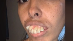 PROMENILA LIČNI OPIS Devojka imala NAJRUŽNIJE zube na svetu, a onda se udala za zubnog hirurga (VIDEO)