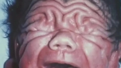 SVI SU BILI ŠOKIRANI Kad se rodio, imao je kožu stogodišnjaka, a pogledajte kako izgleda danas