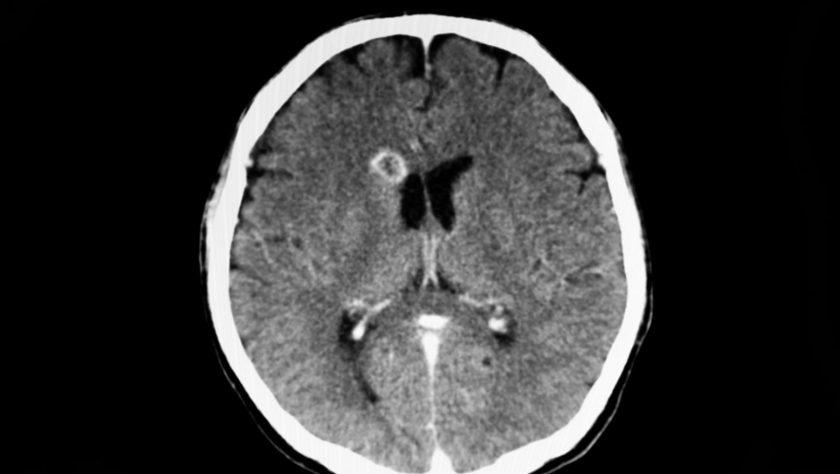 LEKARI MISLILI DA IMA TUMOR, A NJOJ AMEBA IZJELA MOZAK! Baka završila na RESPIRATORU - kad su stigli nalazi doktori su se ŠOKIRALI!