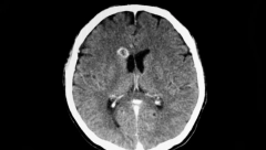 LEKARI MISLILI DA IMA TUMOR, A NJOJ AMEBA IZJELA MOZAK! Baka završila na RESPIRATORU - kad su stigli nalazi doktori su se ŠOKIRALI!
