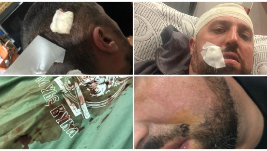 KOSOVSKI SPECIJALCI PRETUKLI SRBINA "NA PRAVDI BOGA" Ima kopče, morali da ga šiju "Menjali su se dok su me tukli" (FOTO)