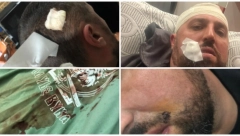 KOSOVSKI SPECIJALCI PRETUKLI SRBINA "NA PRAVDI BOGA" Ima kopče, morali da ga šiju "Menjali su se dok su me tukli" (FOTO)