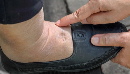 OTIČU VAM RUKE, NOGE I LICE? Moguće je da imate jednu od ovih bolesti