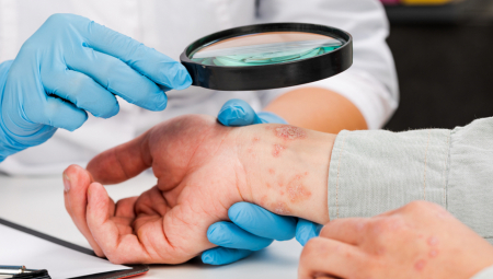 NAUČNICI DOŠLI DO NAPRETKA Identifikovali mogući uzrok lupusa, od koga boluje 5 miliona ljudi širom sveta