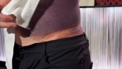SLAVNI KUVAR DOŽIVEO TEŠKU NEZGODU Ovoliku modricu još niste videli, cela strana tela je CRNA (VIDEO)