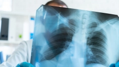 SIMPTOMI RAKA PLUĆA KOJI SE JAVLJAJU KOD NEPUŠAČA Jedna "mrlja" govori mnogo o ovoj podmukloj bolesti