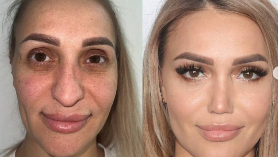 LJUDI ŠOKIRANI TRANSFORMACIJOM: "Nakon ove operacije trebaće joj nova dokumenta" (FOTO)