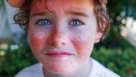 KONZUMIRANJE OVOG SOKA I SUNČANJE MOŽE IZAZVATI OPEKOTINE KOD DECE  Šokirana majka upozorila na posledice, a evo šta se desilo njenom sinčiću