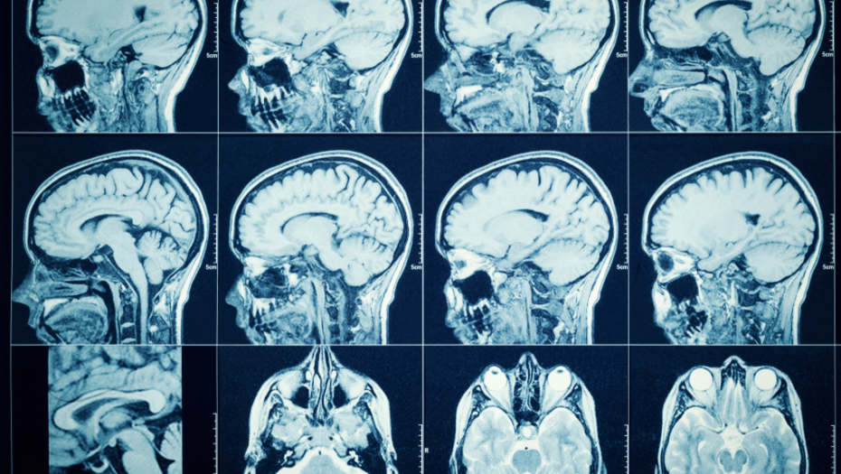 MESECIMA SU GA MUČILE TEŠKE GLAVOBOLJE Kada su videli šta mu živi u mozgu, doktori zanemeli od šoka - sve zbog omiljenog srpskog doručka!