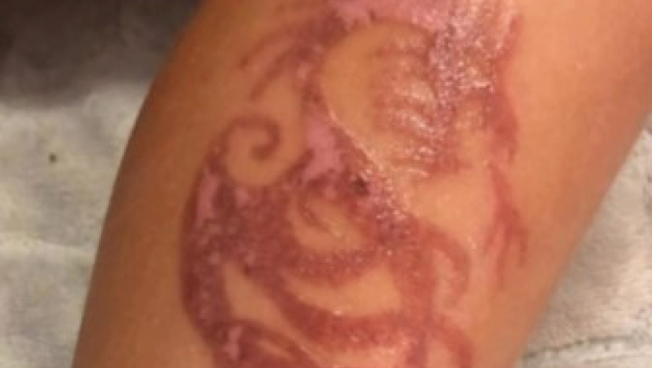 RODITELJI, PAMET U GLAVU Tetovaže kanom su popularne među decom, iskustvo jedne majke pokazuje koliko mogu da budu opasne! (VIDEO)