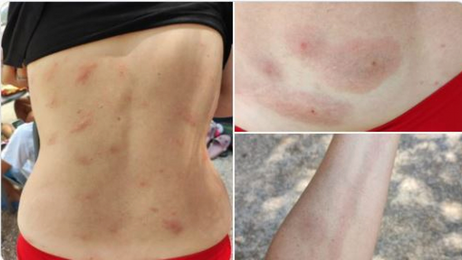 MISTERIOZNA BOLEST HARA HRVATSKIM PRIMORJEM! Turisti iz Slovenije dobili čudan osip: Ne zna se šta je, sumnja se na "peščane mušice"