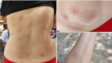 MISTERIOZNA BOLEST HARA HRVATSKIM PRIMORJEM! Turisti iz Slovenije dobili čudan osip: Ne zna se šta je, sumnja se na "peščane mušice"