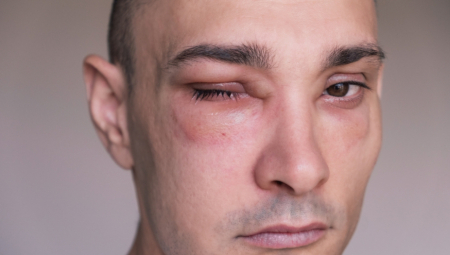 PRIMETIO ROJ POBESNELIH OSA, PA POČEO DA BEŽI KOLIKO GA NOGE NOSE Dobio je preko 160 uboda, lekari nemaju pojma kako je preživeo!