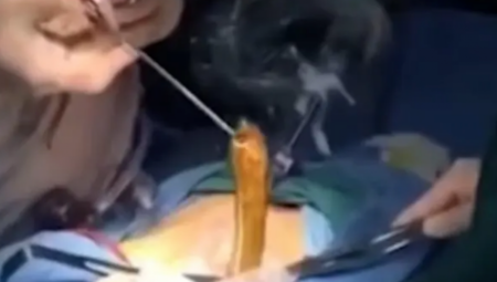 ČOVEKU U STOMAKU PRONAŠLI ZALUTALO BIĆE Doktori ostali u ŠOKU kada im se pred očima stvorila ONA (VIDEO)