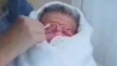 OVA BEBA JE ROĐENA SA VIŠKOM KOŽE, LEKARI NISU VEROVALI SVOJIM OČIMA Pogledajte kako danas izgleda! (FOTO)