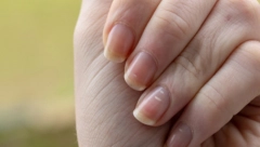 NOKTI I KOŽA SU OGLEDALO ZDRAVLJA Obratite pažnju na 5 promena, mogu ukazati na probleme sa srcem