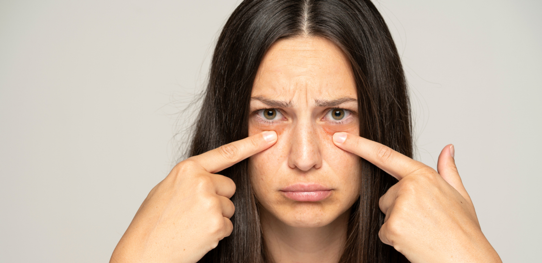 IMATE TAMNE PODOČNJAKE? Oni mogu biti simptom ove bolesti, nisu samo posledica umora