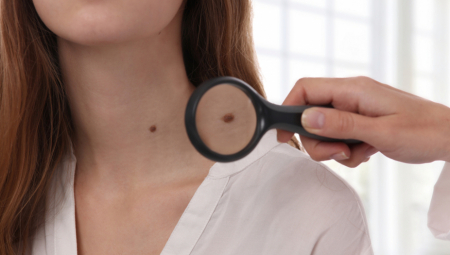 NASTAVLJA SE AKCIJA BESPLATNIH PREGLEDA Udruženje dermatovenerologa Srbije najavilo nastavak prevencije