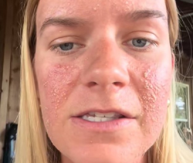 LETOVANJE SE PRETVORILO U HOROR Ujeo je nešto dok je spavala, pa joj se lice IZOBLIČILO – Lekari u šoku, mislili da umišlja! (VIDEO)