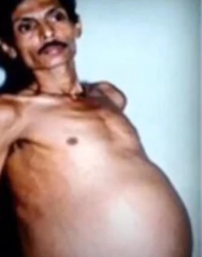 OTKRIVEN FETUS UNUTAR MUŠKARCA NAKON 30 GODINA Ovaj fenomen zaprepastio je lekare i javnost, ovako je izgledao (VIDEO)