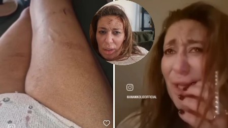 ANA NIKOLIĆ KRVAVA, CELA U MODRICAMA I PODLIVIMA Osvanuli jezivi kadrovi: "Rale mi je zatvorio oko, izubijana sam" (VIDEO)