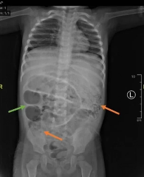 DETE BOLELO STOMAK, DOBILO TEMPERATURU... KADA SU GA LEKARI PREGLEDALI USLEDIO JE ŠOK PRIZOR Crvi samo mile, pogledajte koliko ih ima (FOTO)