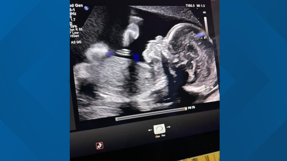 PORODICA U AGONIJI Žena moždano mrtva tri meseca, ali trudnoća mora da se nastavi