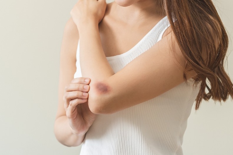 VAŠE TELO VAM ŠALJE ZNAKOVE Kada modrice nisu bezazlene