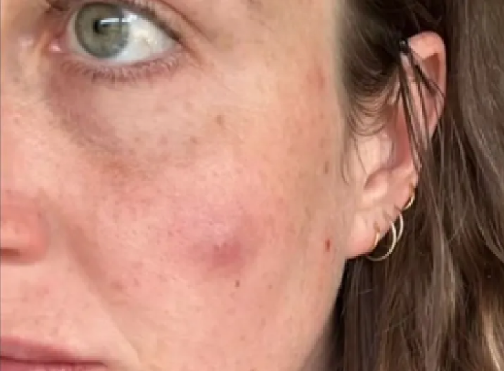 MISLILA JE DA IMA OBIČNU BUBULJICU, ALI ONA SE POVEĆAVALA  Na kraju je završila na operaciji i sa 30 šavova na licu