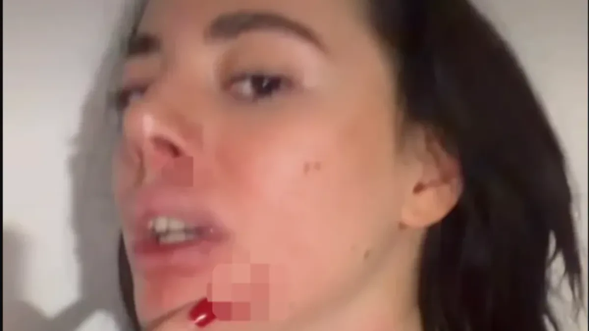Bivšu zadrugarku pretukao dečko! Objavila jezive fotografije: Sva u podlivima, oko zatvoreno od udarca