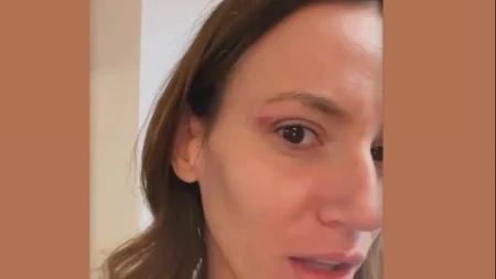 "Razvalio mi je arkadu, isekao me je!" Kristina Spalević pokazala modrice po licu, otkrila šta se desilo na vikendici