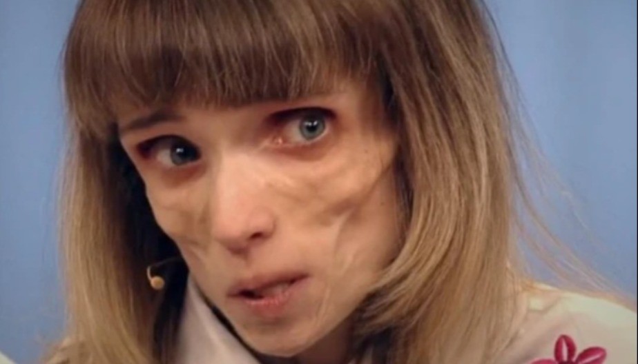 DRAMATIČNA BORBA ZA ŽIVOT Kristina je imala 17 kilograma – ruke i noge kao grančice, pila samo vodu, evo kako živi danas!