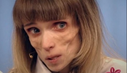 DRAMATIČNA BORBA ZA ŽIVOT Kristina je imala 17 kilograma – ruke i noge kao grančice, pila samo vodu, evo kako živi danas!