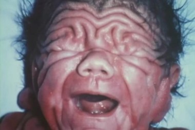 DEČAK ROĐEN SA KOŽOM KAO ŠAR PEJ Lekari se hvatali za glavu - danas izgleda OVAKO!