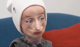 SA 17 GODINA IZGLEDA KAO STARICA OD 80: Tinejdžerka sa retkim sindromom oduševila svet svojom hrabrošću!