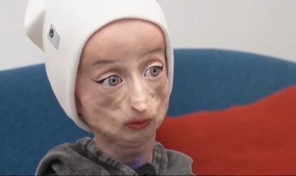 SA 17 GODINA IZGLEDA KAO STARICA OD 80: Tinejdžerka sa retkim sindromom oduševila svet svojom hrabrošću!