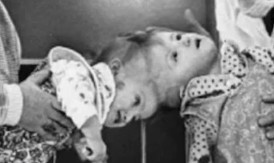 PRIČA KOJA LEDI KRV! Sijamske bliznakinje preživele istorijsku operaciju – pogledajte kako su pobedile nemoguće! (VIDEO)