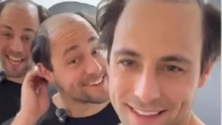 TROJKE IZAZVALE HAOS NA INTERNETU Otišli zajedno na transplantaciju kose – rezultat šokirao sve!