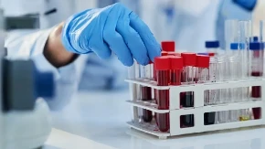 Ovaj nalaz krvi otkriva skriveno zapaljenje u telu: Evo šta znači povišen CRP