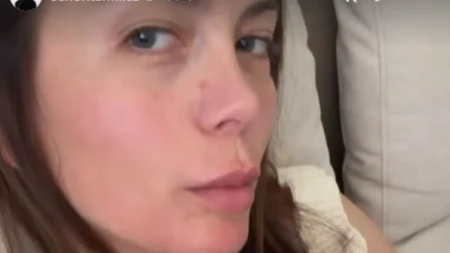Milica Pavlović sva u ogrebotinama i crvenilu! Svi se ptiaju šta se desilo pevačici 