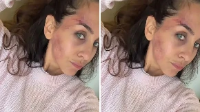 Ivana Dudić sva u modricama: Osvanule fotorgafije povređene glumice