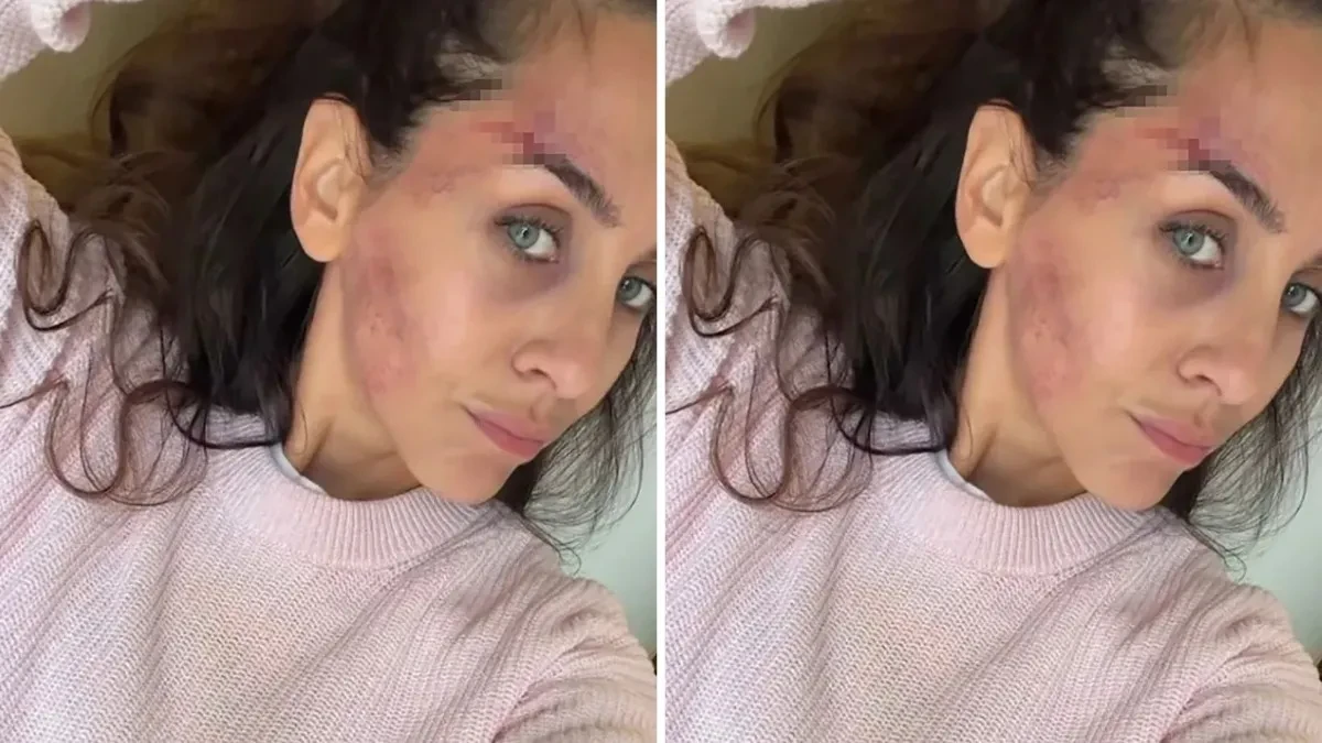 Ivana Dudić sva u modricama: Osvanule fotorgafije povređene glumice