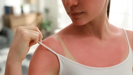 Većina Srba pravi istu grešku čim stigne na more: Zbog ovoga izgore već prvog dana na plaž