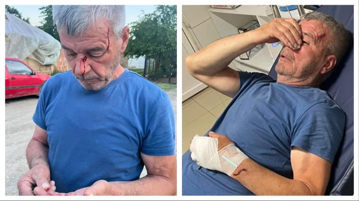 Albanci pretukli Srbina Svetu! Krvav je završio u bolnici