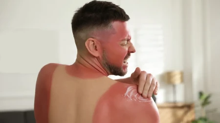 Samo ovo provereno pomaže kod opekotina: Ako izgorite na suncu, ne stavljajte jogurt ili kiselo mleko - ne postoji ništa gore